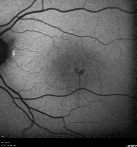 Macular Telangiectasis - visible telangiectasia on color photos
Multicolor photos too show pathology.  This patient had 20/50 vision with pinhole to 20/25
