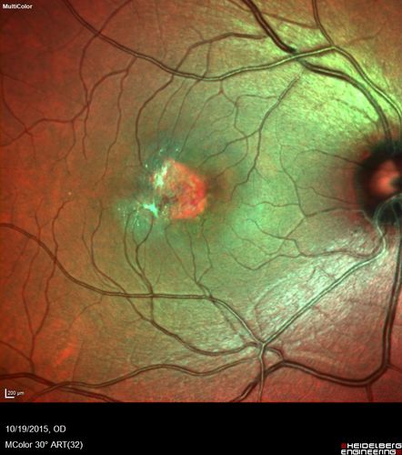 Macular Telangiectasi - Stage V - CNVM OU
60 year old female who has been treated with injections for 5 years starting in the left eye.  She had no treatment 6 months prior to this visit and her vision has been getting worse.  Her vision is 20/100 OD, 20/32 OS.  Vision improved with intravitreal Avastin to 20/30 OU.

