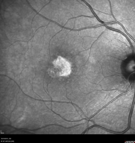 Macular Telangiectasi - Stage V - CNVM OU
60 year old female who has been treated with injections for 5 years starting in the left eye.  She had no treatment 6 months prior to this visit and her vision has been getting worse.  Her vision is 20/100 OD, 20/32 OS.  Vision improved with intravitreal Avastin to 20/30 OU.
