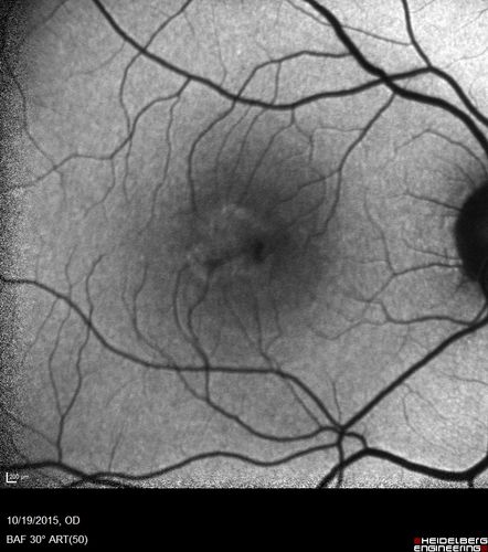 Macular Telangiectasi - Stage V - CNVM OU
60 year old female who has been treated with injections for 5 years starting in the left eye.  She had no treatment 6 months prior to this visit and her vision has been getting worse.  Her vision is 20/100 OD, 20/32 OS.  Vision improved with intravitreal Avastin to 20/30 OU.
