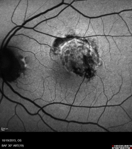 Macular Telangiectasi - Stage V - CNVM OU
60 year old female who has been treated with injections for 5 years starting in the left eye.  She had no treatment 6 months prior to this visit and her vision has been getting worse.  Her vision is 20/100 OD, 20/32 OS.  Vision improved with intravitreal Avastin to 20/30 OU.
