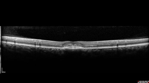 Macular Telangiectasi - Stage V - CNVM OU
60 year old female who has been treated with injections for 5 years starting in the left eye.  She had no treatment 6 months prior to this visit and her vision has been getting worse.  Her vision is 20/100 OD, 20/32 OS.  Vision improved with intravitreal Avastin to 20/30 OU.
