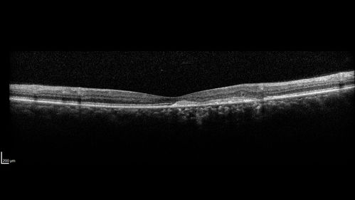 Macular Telangiectasi - Stage V - CNVM OU
60 year old female who has been treated with injections for 5 years starting in the left eye.  She had no treatment 6 months prior to this visit and her vision has been getting worse.  Her vision is 20/100 OD, 20/32 OS.  Vision improved with intravitreal Avastin to 20/30 OU.
