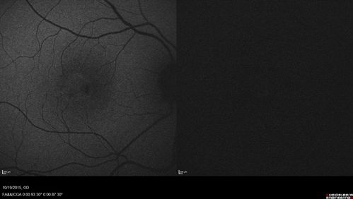 Macular Telangiectasi - Stage V - CNVM OU
60 year old female who has been treated with injections for 5 years starting in the left eye.  She had no treatment 6 months prior to this visit and her vision has been getting worse.  Her vision is 20/100 OD, 20/32 OS.  Vision improved with intravitreal Avastin to 20/30 OU.

