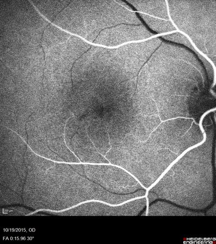 Macular Telangiectasi - Stage V - CNVM OU
60 year old female who has been treated with injections for 5 years starting in the left eye.  She had no treatment 6 months prior to this visit and her vision has been getting worse.  Her vision is 20/100 OD, 20/32 OS.  Vision improved with intravitreal Avastin to 20/30 OU.
