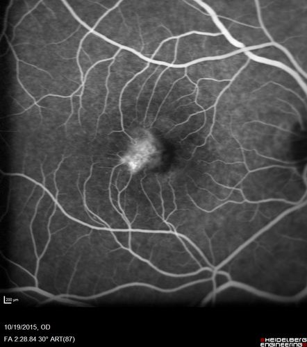 Macular Telangiectasi - Stage V - CNVM OU
60 year old female who has been treated with injections for 5 years starting in the left eye.  She had no treatment 6 months prior to this visit and her vision has been getting worse.  Her vision is 20/100 OD, 20/32 OS.  Vision improved with intravitreal Avastin to 20/30 OU.
