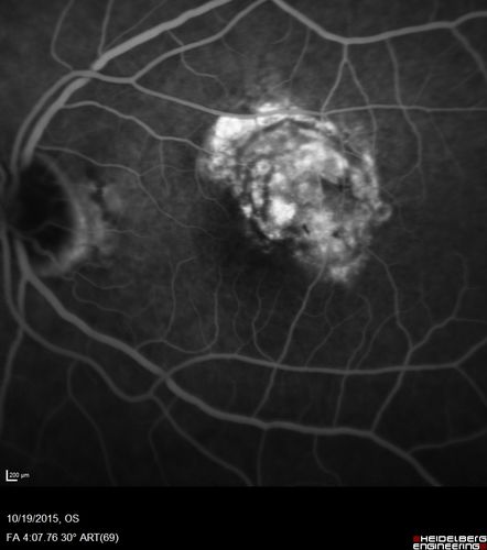 Macular Telangiectasi - Stage V - CNVM OU
60 year old female who has been treated with injections for 5 years starting in the left eye.  She had no treatment 6 months prior to this visit and her vision has been getting worse.  Her vision is 20/100 OD, 20/32 OS.  Vision improved with intravitreal Avastin to 20/30 OU.
