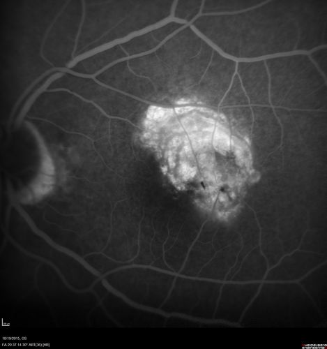 Macular Telangiectasi - Stage V - CNVM OU
60 year old female who has been treated with injections for 5 years starting in the left eye.  She had no treatment 6 months prior to this visit and her vision has been getting worse.  Her vision is 20/100 OD, 20/32 OS.  Vision improved with intravitreal Avastin to 20/30 OU.
