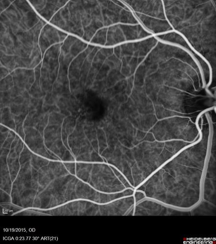 Macular Telangiectasi - Stage V - CNVM OU
60 year old female who has been treated with injections for 5 years starting in the left eye.  She had no treatment 6 months prior to this visit and her vision has been getting worse.  Her vision is 20/100 OD, 20/32 OS.  Vision improved with intravitreal Avastin to 20/30 OU.
