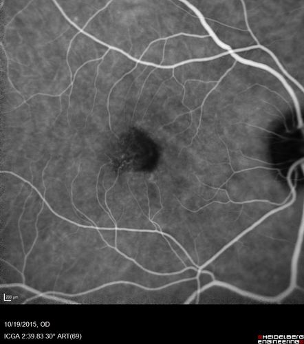 Macular Telangiectasi - Stage V - CNVM OU
60 year old female who has been treated with injections for 5 years starting in the left eye.  She had no treatment 6 months prior to this visit and her vision has been getting worse.  Her vision is 20/100 OD, 20/32 OS.  Vision improved with intravitreal Avastin to 20/30 OU.
