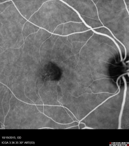 Macular Telangiectasi - Stage V - CNVM OU
60 year old female who has been treated with injections for 5 years starting in the left eye.  She had no treatment 6 months prior to this visit and her vision has been getting worse.  Her vision is 20/100 OD, 20/32 OS.  Vision improved with intravitreal Avastin to 20/30 OU.
