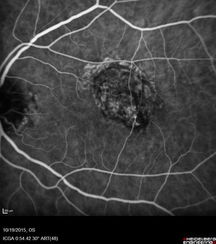 Macular Telangiectasi - Stage V - CNVM OU
60 year old female who has been treated with injections for 5 years starting in the left eye.  She had no treatment 6 months prior to this visit and her vision has been getting worse.  Her vision is 20/100 OD, 20/32 OS.  Vision improved with intravitreal Avastin to 20/30 OU.
