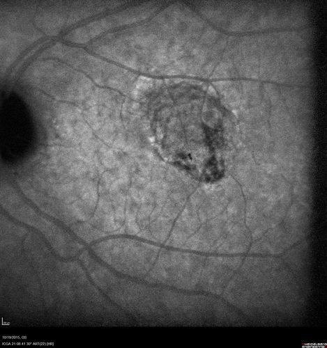 Macular Telangiectasi - Stage V - CNVM OU
60 year old female who has been treated with injections for 5 years starting in the left eye.  She had no treatment 6 months prior to this visit and her vision has been getting worse.  Her vision is 20/100 OD, 20/32 OS.  Vision improved with intravitreal Avastin to 20/30 OU.

