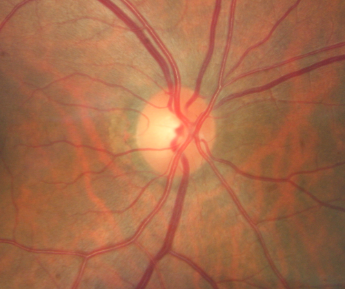 Macular Telangiectasis with Symptomatic Blind Spots
55 year old man with non-neovascular MacTel.  VA 20/20 right eye 20/50 left eye.  The color images show gray areas temporally.  The FAF shows decreased macular pigment.  The OCT shows outer retinal atrophy.
