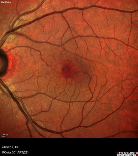 Macular Telangiectasis with Symptomatic Blind Spots
55 year old man with non-neovascular MacTel.  VA 20/20 right eye 20/50 left eye.  The color images show gray areas temporally.  The FAF shows decreased macular pigment.  The OCT shows outer retinal atrophy.
