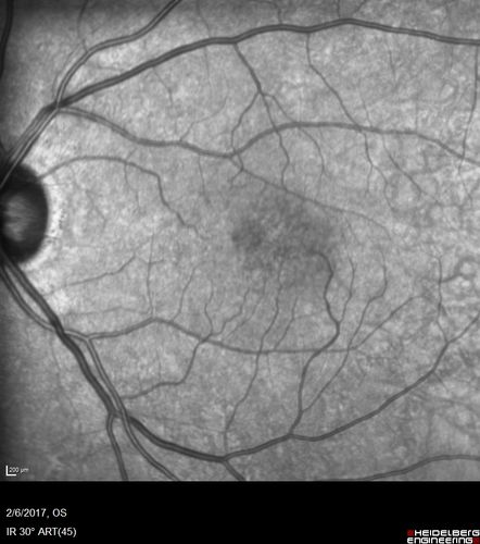Macular Telangiectasis with Symptomatic Blind Spots
55 year old man with non-neovascular MacTel.  VA 20/20 right eye 20/50 left eye.  The color images show gray areas temporally.  The FAF shows decreased macular pigment.  The OCT shows outer retinal atrophy.
