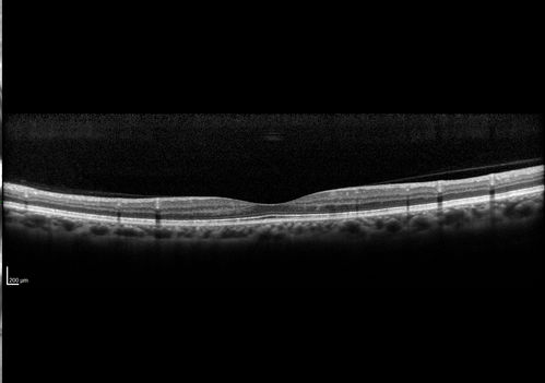 Macular Telangiectasis with Symptomatic Blind Spots
55 year old man with non-neovascular MacTel.  VA 20/20 right eye 20/50 left eye.  The color images show gray areas temporally.  The FAF shows decreased macular pigment.  The OCT shows outer retinal atrophy.
