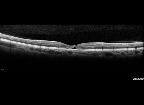 Macular Telangiectasis with Symptomatic Blind Spots
55 year old man with non-neovascular MacTel.  VA 20/20 right eye 20/50 left eye.  The color images show gray areas temporally.  The FAF shows decreased macular pigment.  The OCT shows outer retinal atrophy.
