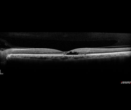 Macular Telangiectasis with Symptomatic Blind Spots
55 year old man with non-neovascular MacTel.  VA 20/20 right eye 20/50 left eye.  The color images show gray areas temporally.  The FAF shows decreased macular pigment.  The OCT shows outer retinal atrophy.
