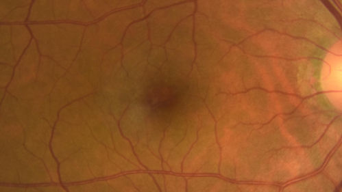 MacTel - Juxtafoveal Telangiectasis
56 year old man with a lot of difficulty adjusting to vision loss
