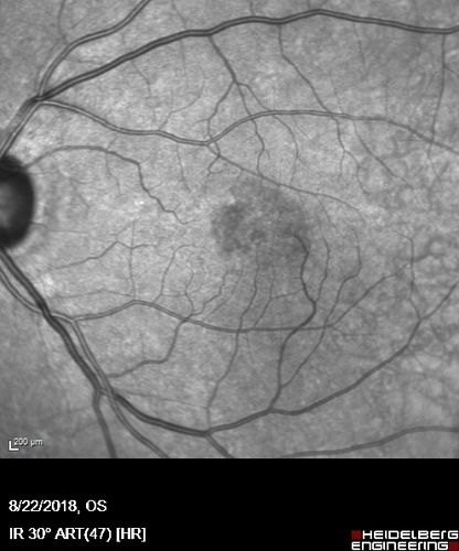 MacTel - Juxtafoveal Telangiectasis
56 year old man with a lot of difficulty adjusting to vision loss
