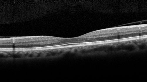 MacTel - Juxtafoveal Telangiectasis
56 year old man with a lot of difficulty adjusting to vision loss
