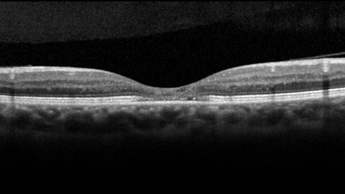 MacTel - Juxtafoveal Telangiectasis
56 year old man with a lot of difficulty adjusting to vision loss
