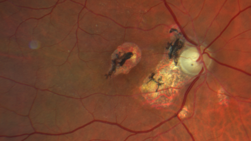 Macular Telangiectasis and Vision loss following vitrectomy with membrane peel
76 year old man with MacTel who had membrane peel in the right eye 10 years ago with permanent vision loss.  
VA OD: sc20/200-4 and VA OS: sc20/25-1
