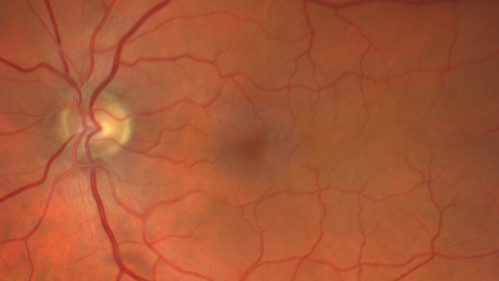 Macular Telangiectasis and Vision loss following vitrectomy with membrane peel
76 year old man with MacTel who had membrane peel in the right eye 10 years ago with permanent vision loss.  
VA OD: sc20/200-4 and VA OS: sc20/25-1
