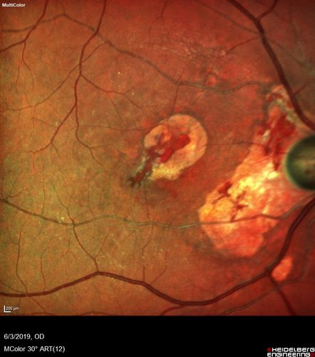 Macular Telangiectasis and Vision loss following vitrectomy with membrane peel
76 year old man with MacTel who had membrane peel in the right eye 10 years ago with permanent vision loss.  
VA OD: sc20/200-4 and VA OS: sc20/25-1
