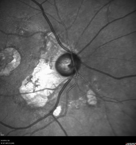 Macular Telangiectasis and Vision loss following vitrectomy with membrane peel
76 year old man with MacTel who had membrane peel in the right eye 10 years ago with permanent vision loss.  
VA OD: sc20/200-4 and VA OS: sc20/25-1
