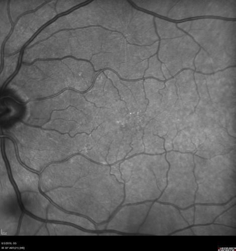 Macular Telangiectasis and Vision loss following vitrectomy with membrane peel
76 year old man with MacTel who had membrane peel in the right eye 10 years ago with permanent vision loss.  
VA OD: sc20/200-4 and VA OS: sc20/25-1
