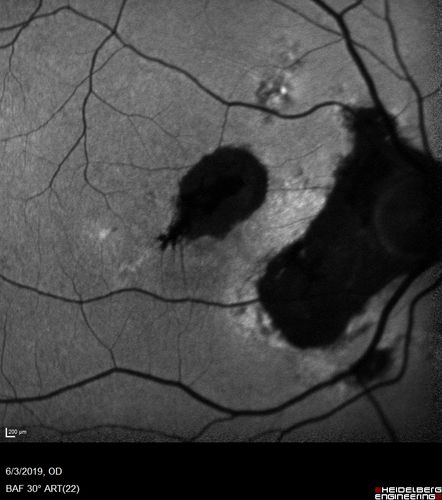 Macular Telangiectasis and Vision loss following vitrectomy with membrane peel
76 year old man with MacTel who had membrane peel in the right eye 10 years ago with permanent vision loss.  
VA OD: sc20/200-4 and VA OS: sc20/25-1
