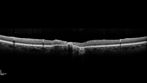 Macular Telangiectasis and Vision loss following vitrectomy with membrane peel
76 year old man with MacTel who had membrane peel in the right eye 10 years ago with permanent vision loss.  
VA OD: sc20/200-4 and VA OS: sc20/25-1
