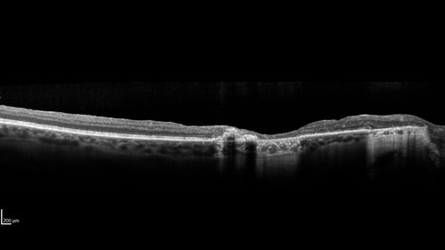 Macular Telangiectasis and Vision loss following vitrectomy with membrane peel
76 year old man with MacTel who had membrane peel in the right eye 10 years ago with permanent vision loss.  
VA OD: sc20/200-4 and VA OS: sc20/25-1

