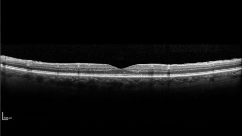 Macular Telangiectasis and Vision loss following vitrectomy with membrane peel
76 year old man with MacTel who had membrane peel in the right eye 10 years ago with permanent vision loss.  
VA OD: sc20/200-4 and VA OS: sc20/25-1
