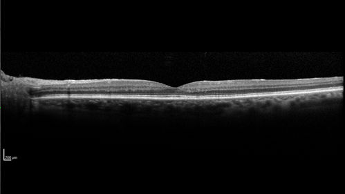 Macular Telangiectasis and Vision loss following vitrectomy with membrane peel
76 year old man with MacTel who had membrane peel in the right eye 10 years ago with permanent vision loss.  
VA OD: sc20/200-4 and VA OS: sc20/25-1
