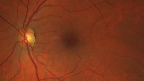 Macular Telangiectasia - Mild
56 year old female with good vision and mild macular telangiectasia.  VA 20/40 OD 20/16 OS
