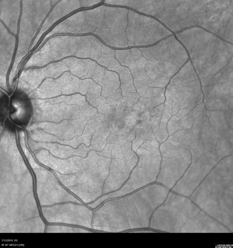 Macular Telangiectasia - Mild
56 year old female with good vision and mild macular telangiectasia.  VA 20/40 OD 20/16 OS
