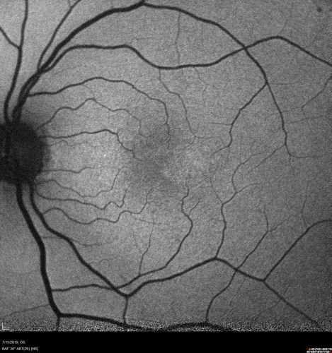 Macular Telangiectasia - Mild
56 year old female with good vision and mild macular telangiectasia.  VA 20/40 OD 20/16 OS
