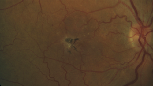 Stage V (neovascular) Macular Telangiectasia - Fluorescein
67 year old female with vision in only the left eye.  She has mild CNVM which is treated with Avastin and does well over several  years.
