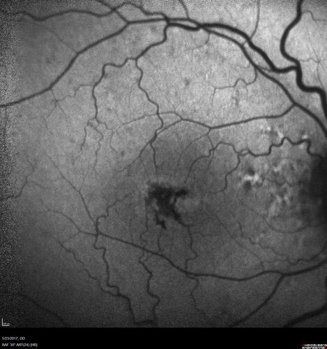 Stage V (neovascular) Macular Telangiectasia - Fluorescein
67 year old female with vision in only the left eye.  She has mild CNVM which is treated with Avastin and does well over several  years.
