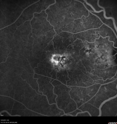 Stage V (neovascular) Macular Telangiectasia - Fluorescein
67 year old female with vision in only the left eye.  She has mild CNVM which is treated with Avastin and does well over several  years.
