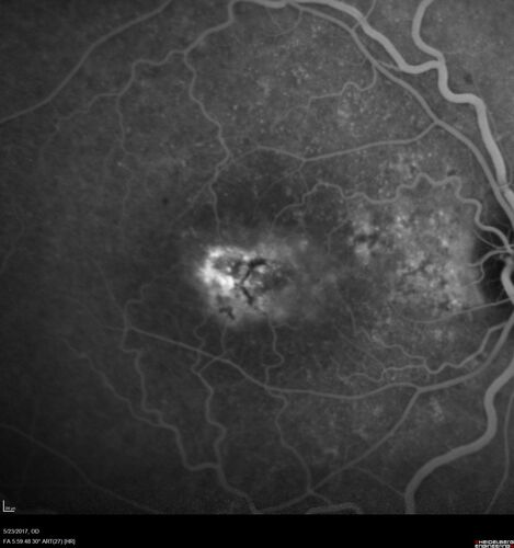 Stage V (neovascular) Macular Telangiectasia - Fluorescein
67 year old female with vision in only the left eye.  She has mild CNVM which is treated with Avastin and does well over several  years.
