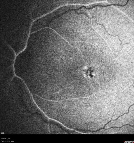 Stage V (neovascular) Macular Telangiectasia - Fluorescein
67 year old female with vision in only the left eye.  She has mild CNVM which is treated with Avastin and does well over several  years.
