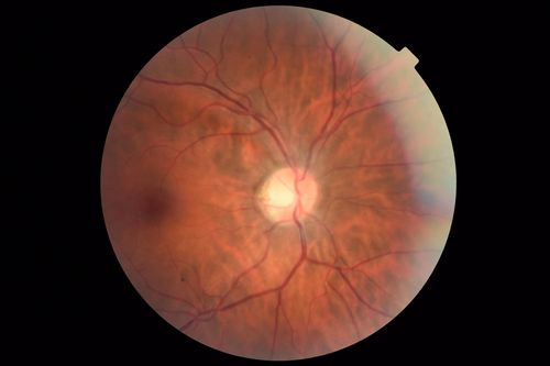 Macular Telangiectasis - Very Mild
52 year old female with normal vision and suspicious OCT referred.  Multimodal imaging shows very mild mactel (loss of macular pigment, ring on multicolor image and very mild OCT findings)
