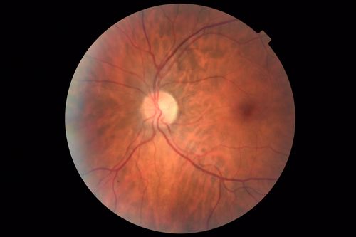 Macular Telangiectasis - Very Mild
52 year old female with normal vision and suspicious OCT referred.  Multimodal imaging shows very mild mactel (loss of macular pigment, ring on multicolor image and very mild OCT findings)

