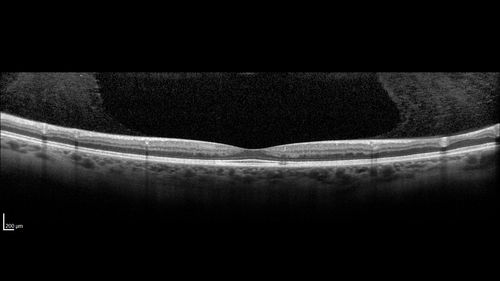 Macular Telangiectasis - Very Mild
52 year old female with normal vision and suspicious OCT referred.  Multimodal imaging shows very mild mactel (loss of macular pigment, ring on multicolor image and very mild OCT findings)
