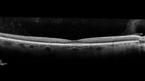 Macular Telangiectasis - Very Mild
52 year old female with normal vision and suspicious OCT referred.  Multimodal imaging shows very mild mactel (loss of macular pigment, ring on multicolor image and very mild OCT findings)
