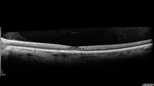 Macular Telangiectasis - Very Mild
52 year old female with normal vision and suspicious OCT referred.  Multimodal imaging shows very mild mactel (loss of macular pigment, ring on multicolor image and very mild OCT findings)
